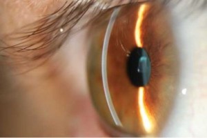 catarata curitiba biometria ocular